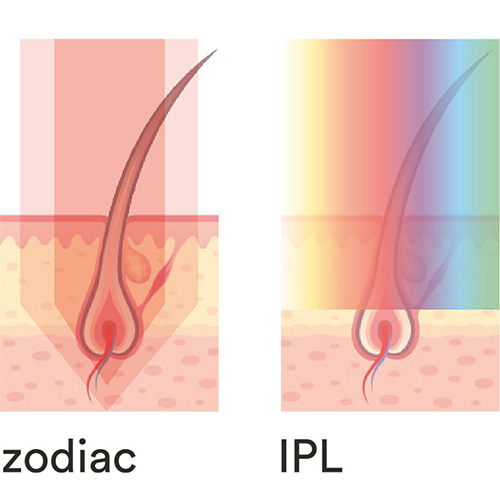 zodiac-vs-ipl-neu