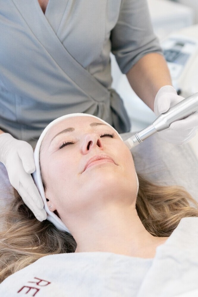 Microneedling-Reviderm-skinmedics-Baden